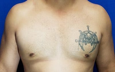 Gynecomastia Before & After Gallery - Patient 187372 - Image 2