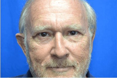 Eyelid Lift Before & After Gallery - Patient 291690 - Image 2