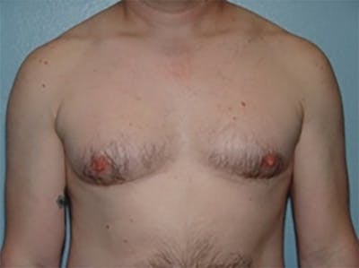 Gynecomastia Before & After Gallery - Patient 342974 - Image 1