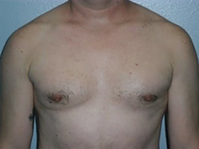 Gynecomastia Before & After Gallery - Patient 342974 - Image 2