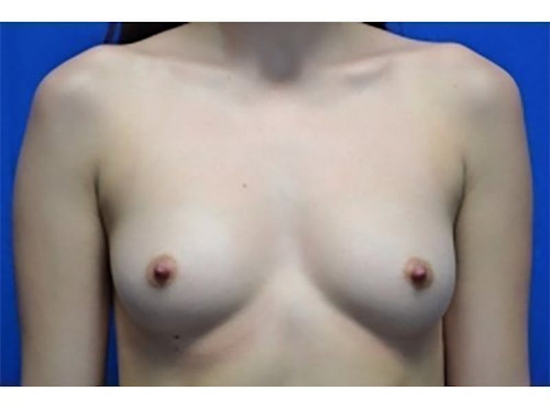 Breast Augmentation Before & After Gallery - Patient 136199 - Image 1