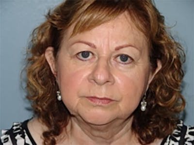 Eyelid Lift Before & After Gallery - Patient 168153 - Image 1