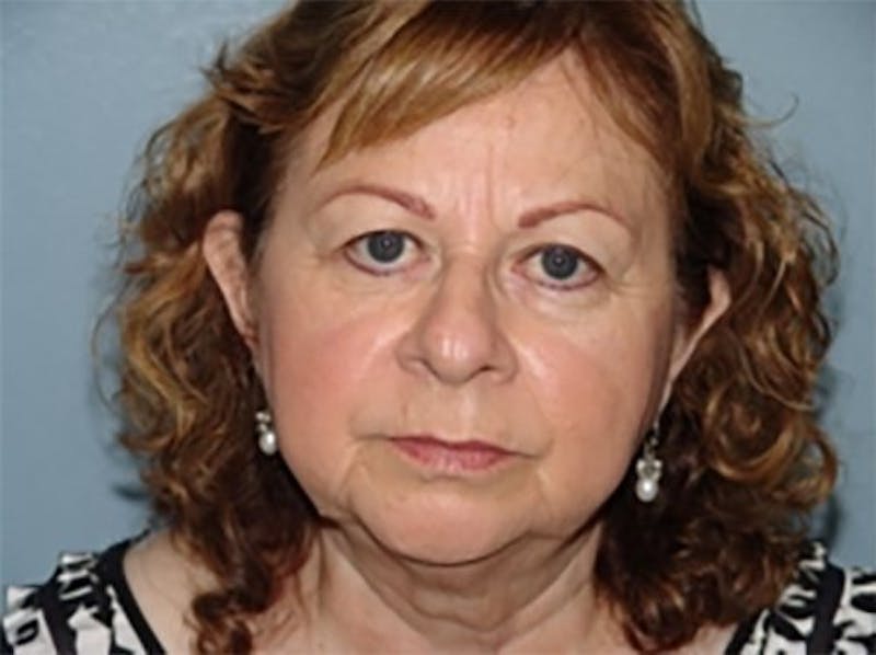 Eyelid Lift Before & After Gallery - Patient 168153 - Image 1