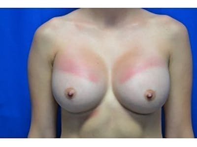 Breast Augmentation Before & After Gallery - Patient 136199 - Image 2