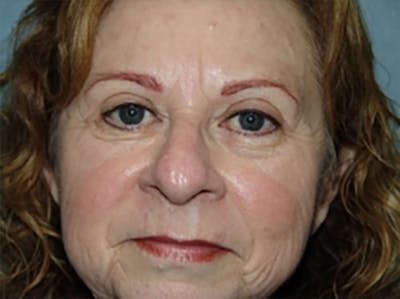 Eyelid Lift Before & After Gallery - Patient 168153 - Image 2