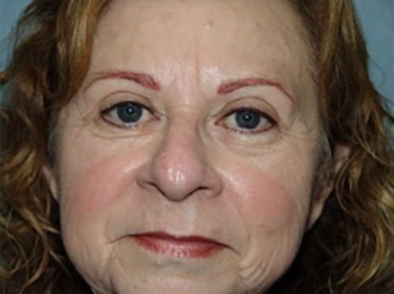 Eyelid Lift Before & After Gallery - Patient 168153 - Image 2