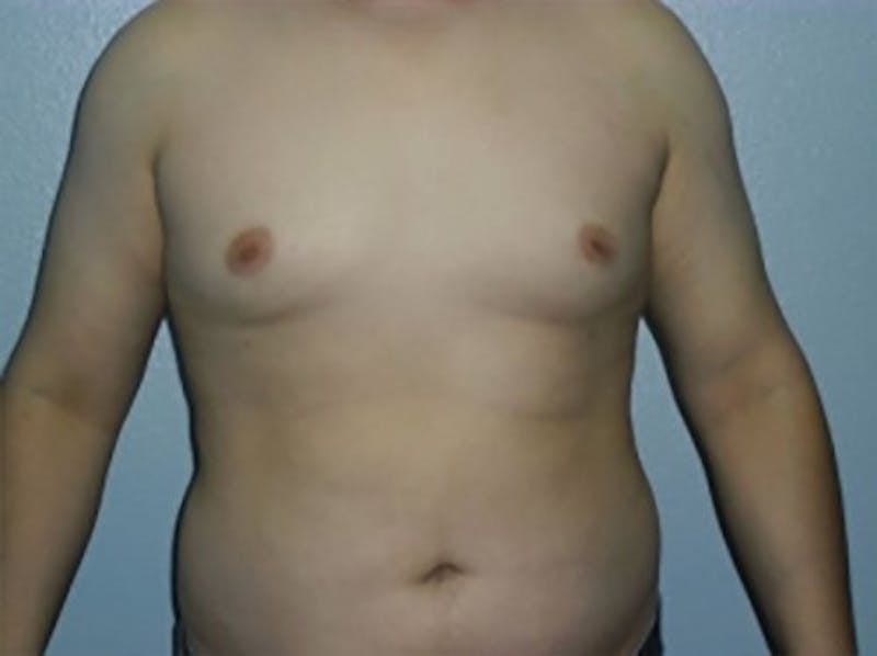 Gynecomastia Before & After Gallery - Patient 601243 - Image 2