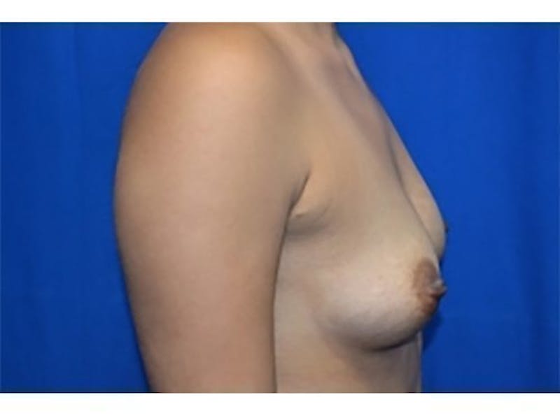 Breast Augmentation Before & After Gallery - Patient 177646 - Image 1