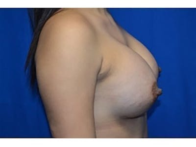 Breast Augmentation Before & After Gallery - Patient 177646 - Image 2