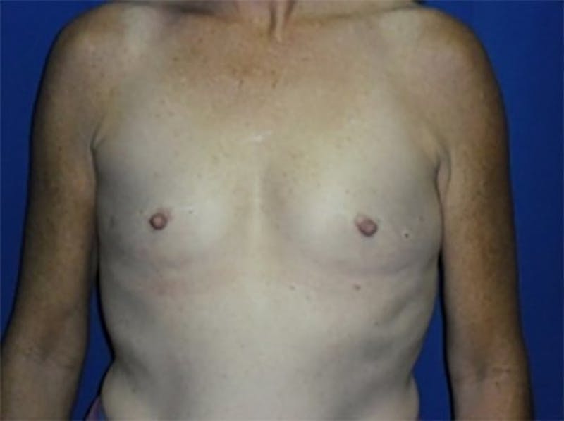 Breast Augmentation Before & After Gallery - Patient 545833 - Image 1