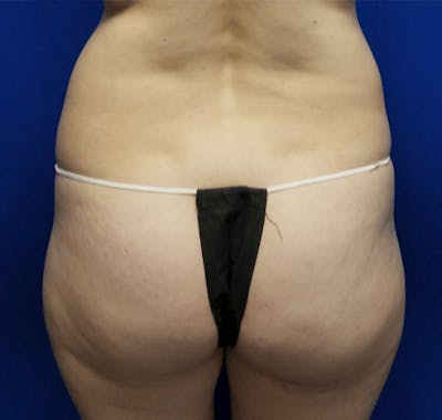 Liposuction Before & After Gallery - Patient 245512 - Image 1