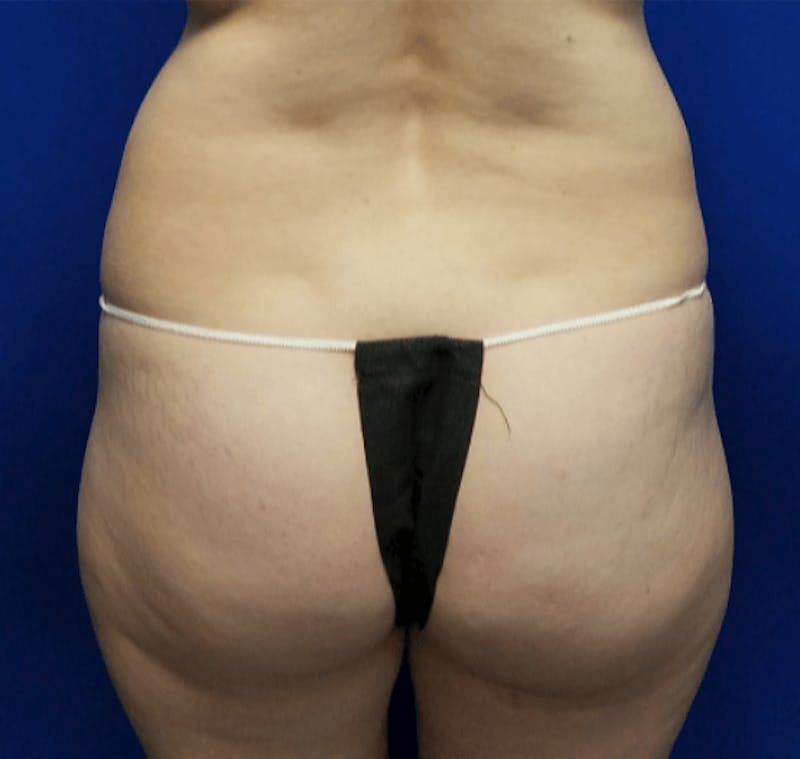 Liposuction Before & After Gallery - Patient 245512 - Image 1