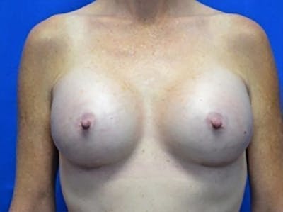 Breast Augmentation Before & After Gallery - Patient 545833 - Image 2