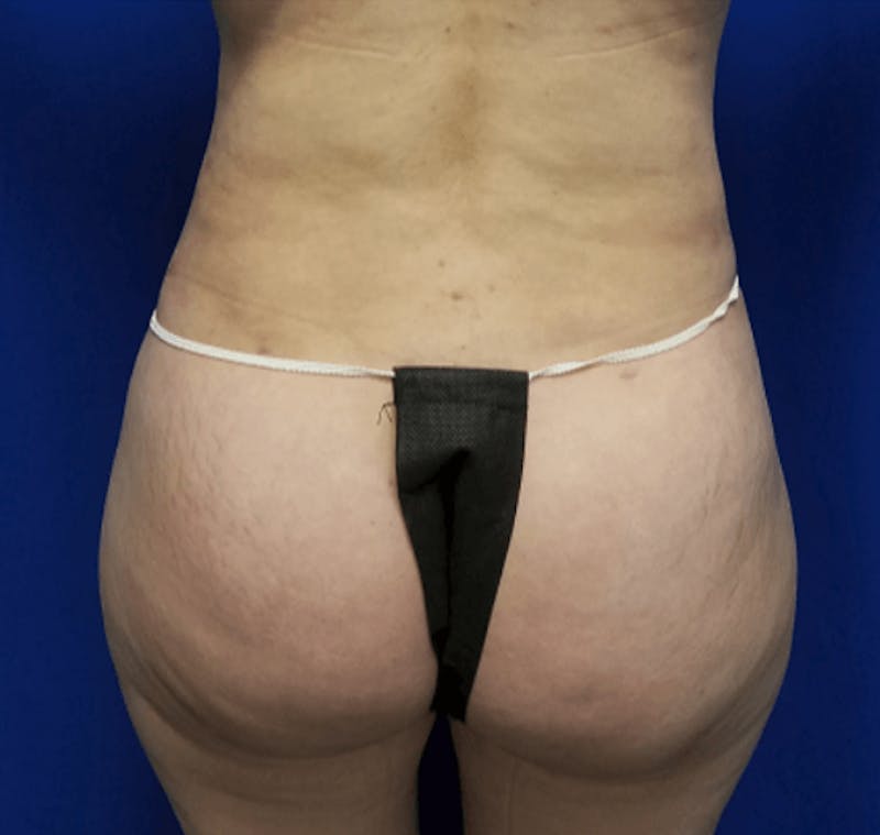 Liposuction Before & After Gallery - Patient 245512 - Image 2