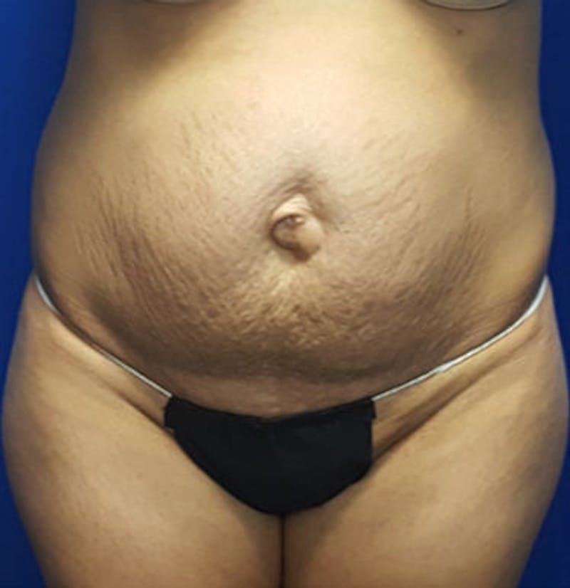 Liposuction Before & After Gallery - Patient 294464 - Image 1