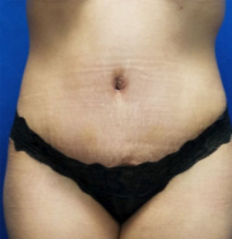 Liposuction Before & After Gallery - Patient 294464 - Image 2