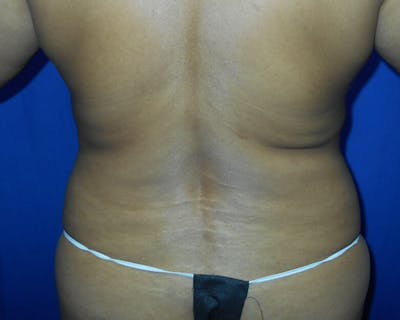 Liposuction Before & After Gallery - Patient 438625 - Image 1