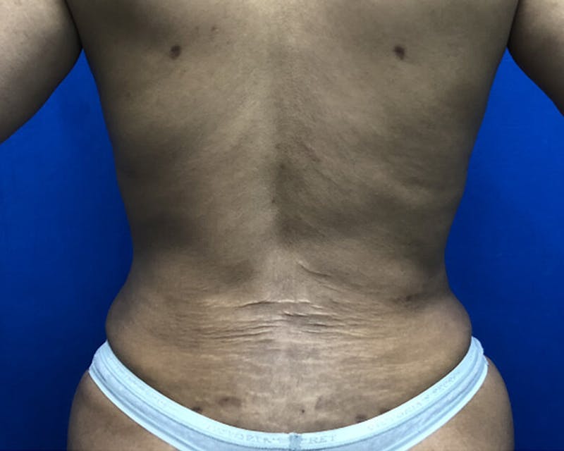 Liposuction Before & After Gallery - Patient 438625 - Image 2