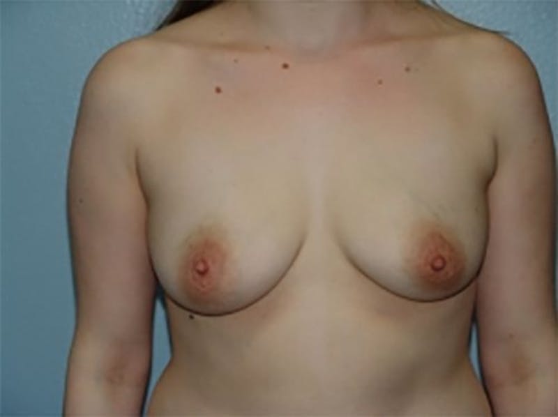 Breast Augmentation Before & After Gallery - Patient 310963 - Image 1