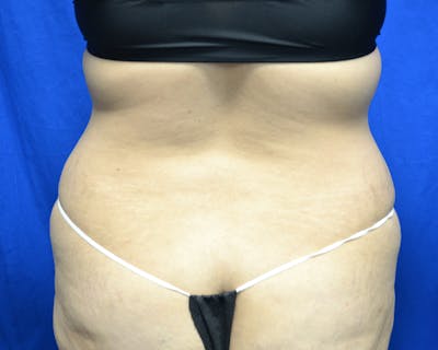 Liposuction Before & After Gallery - Patient 842796 - Image 1