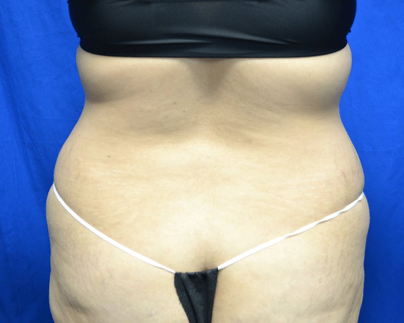 Liposuction Before & After Gallery - Patient 842796 - Image 1