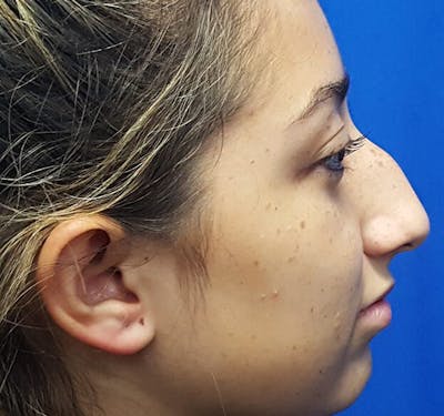 Rhinoplasty Before & After Gallery - Patient 175930 - Image 1