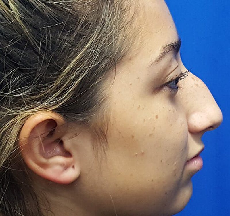 Rhinoplasty Before & After Gallery - Patient 175930 - Image 1