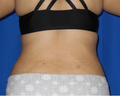 Liposuction Before & After Gallery - Patient 842796 - Image 2