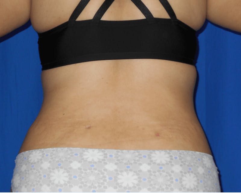 Liposuction Before & After Gallery - Patient 842796 - Image 2