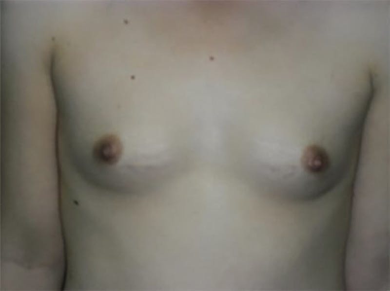 Breast Augmentation Before & After Gallery - Patient 137611 - Image 1