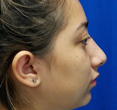 Rhinoplasty Before & After Gallery - Patient 175930 - Image 2