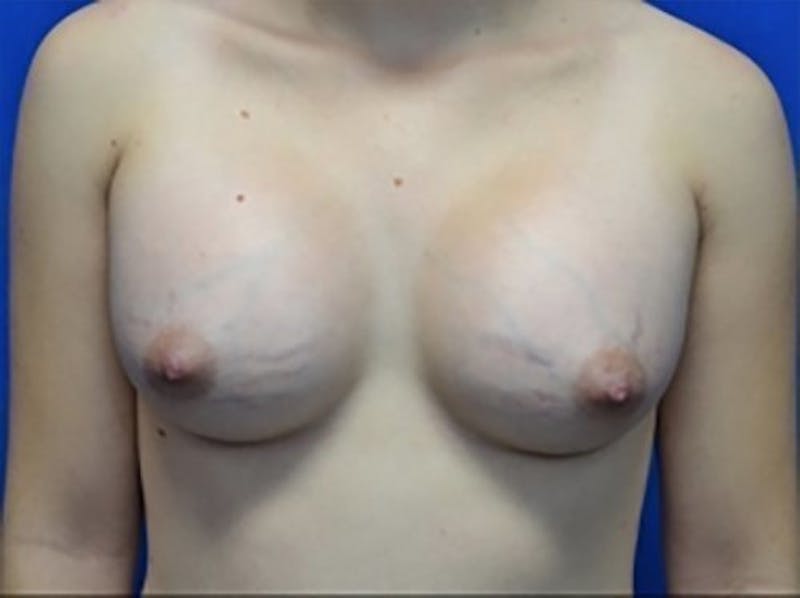 Breast Augmentation Before & After Gallery - Patient 137611 - Image 2