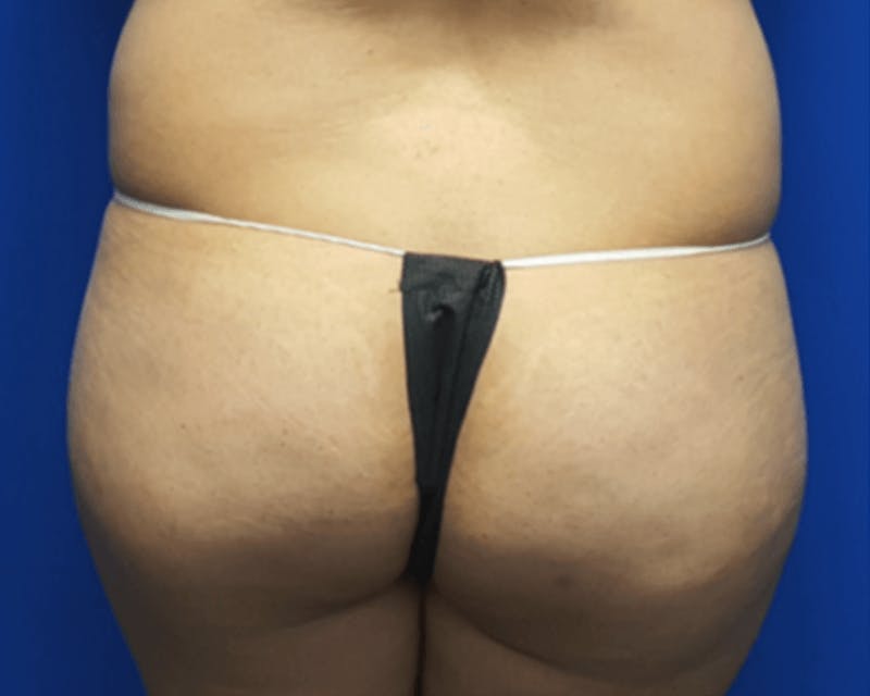 Liposuction Before & After Gallery - Patient 127354 - Image 1