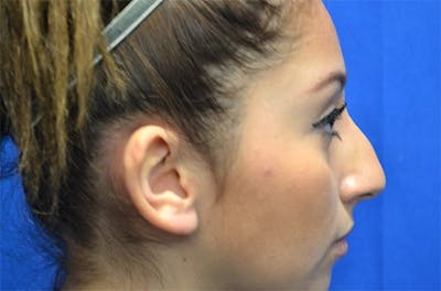Rhinoplasty Before & After Gallery - Patient 386991 - Image 1