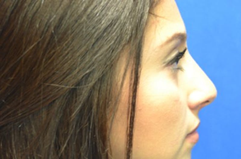 Rhinoplasty Before & After Gallery - Patient 386991 - Image 2