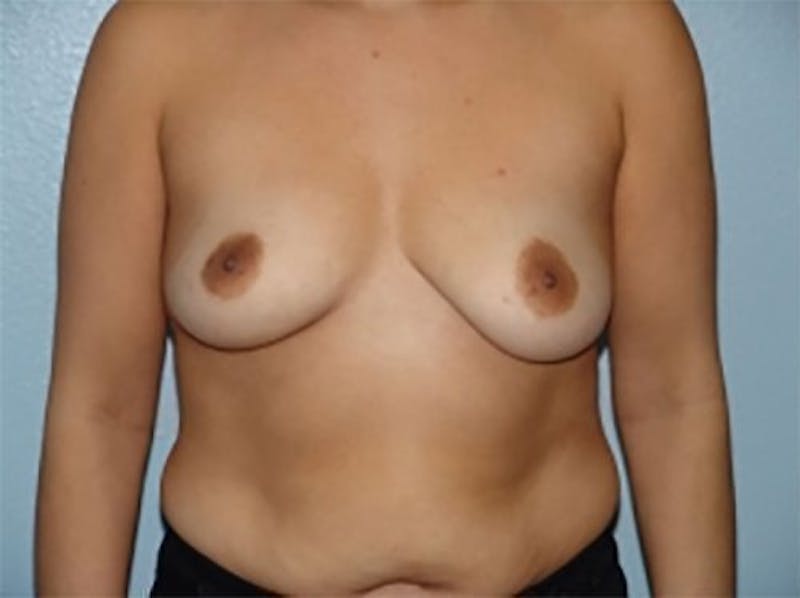 Breast Augmentation Before & After Gallery - Patient 341576 - Image 1