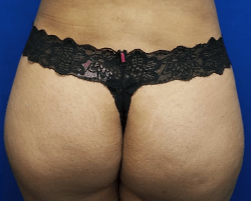 Liposuction Before & After Gallery - Patient 127354 - Image 2