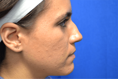 Rhinoplasty Before & After Gallery - Patient 217781 - Image 1