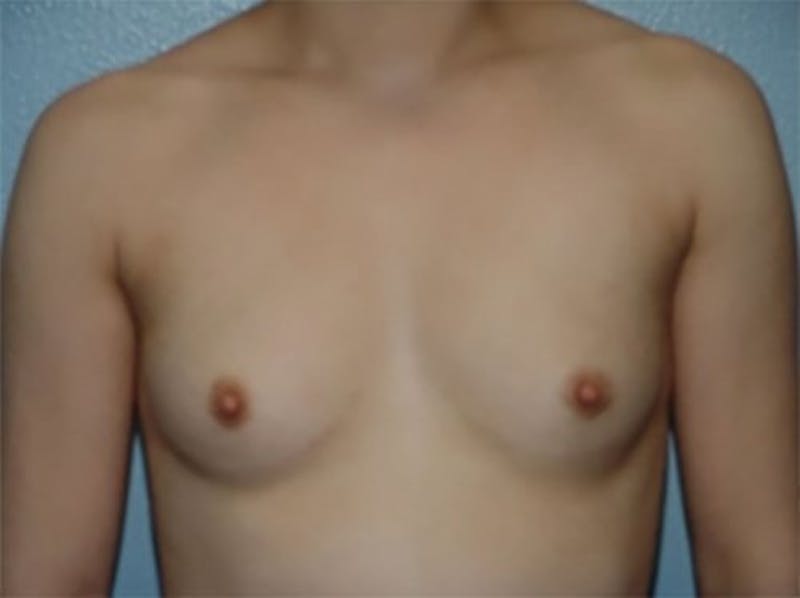 Breast Augmentation Before & After Gallery - Patient 313561 - Image 1