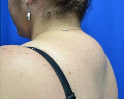Liposuction Before & After Gallery - Patient 213647 - Image 1