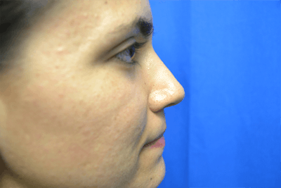 Rhinoplasty Before & After Gallery - Patient 217781 - Image 2