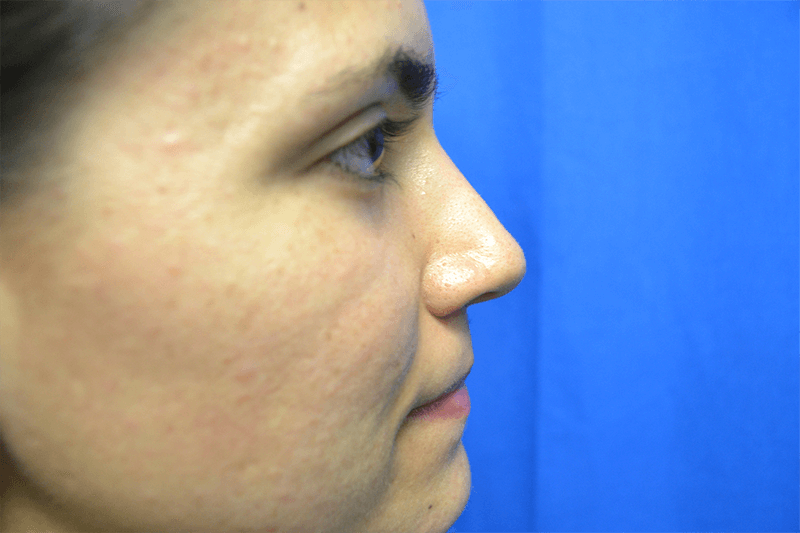 Rhinoplasty Before & After Gallery - Patient 217781 - Image 2