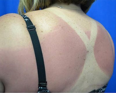 Liposuction Before & After Gallery - Patient 213647 - Image 2