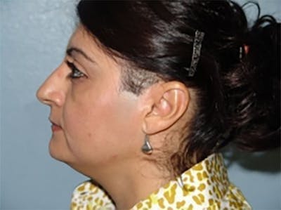 Rhinoplasty Before & After Gallery - Patient 305703 - Image 1