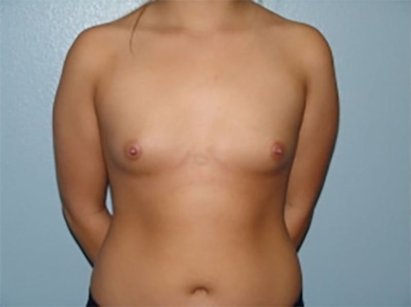 Breast Augmentation Before & After Gallery - Patient 415487 - Image 1