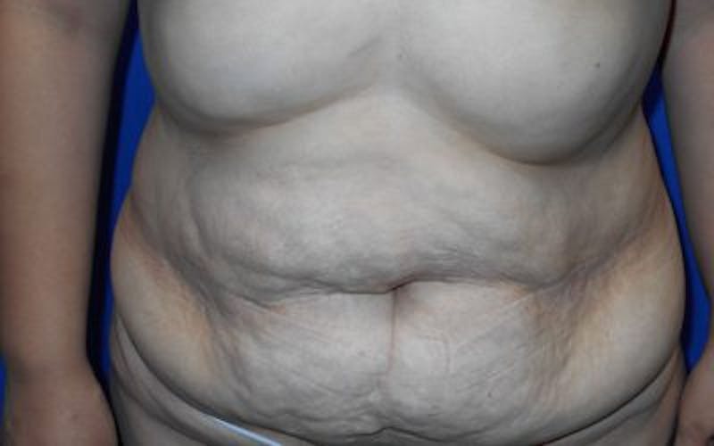 Tummy Tuck Before & After Gallery - Patient 200003 - Image 1
