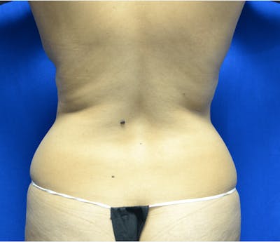 Liposuction Before & After Gallery - Patient 140382 - Image 1
