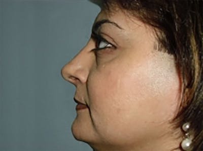 Rhinoplasty Before & After Gallery - Patient 305703 - Image 2