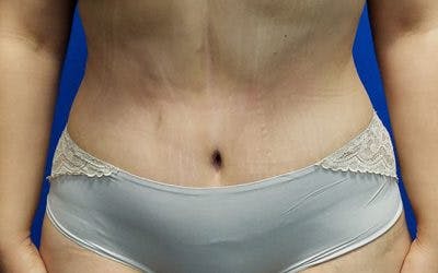 Tummy Tuck Before & After Gallery - Patient 200003 - Image 2