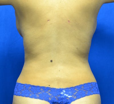 Liposuction Before & After Gallery - Patient 140382 - Image 2